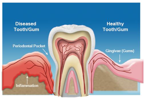 Gum Disease