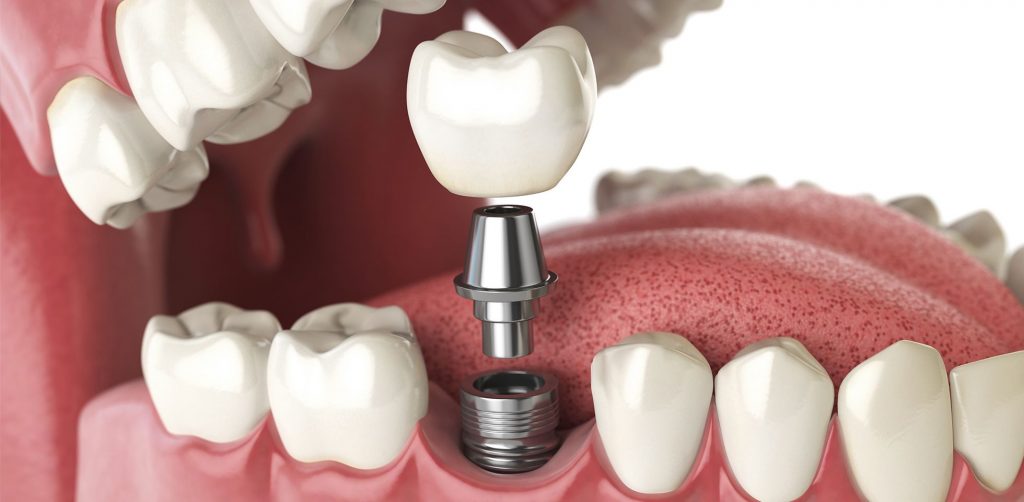 Dental Implants Dental Implants
